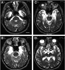 Image result for Temporal Lobe