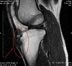 Cureus Osgood Schlatter Lesion Removed Arthroscopically In An Adult Patient