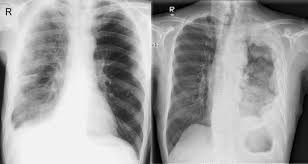 Mesothelioma is a cancer of the mesothelium. Epos Trade