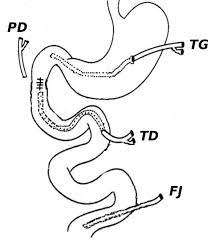 Diagramatic representation of triple tubostomy. TG-Tube Gastrostomy... |  Download Scientific Diagram
