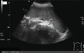 Image result for Splenomegaly