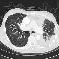 Your family's life will never be the same. Mesothelioma Radiology Case Radiopaedia Org
