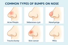 Image result for skin cancer on nose pimple