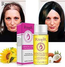 Hair loss shouldn't hinder you from feeling beautiful or proud, which is why we present you this herbal hair loss herbal hair loss treatment. Hot Herbal Hair Growth Anti Hair Loss Liquid Promote Thick Fast Hair Growth Treatment 20ml Essential Oil Health Care Beauty Essence Buy Online In Bahamas At Bahamas Desertcart Com Productid 94979213
