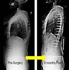 Thank you so so much for this answer! Patient Stories Scoliosis And Spine Associates