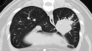 And if you already have asthma, it may get worse. Secondhand Smoke As Harmful To Pets As People