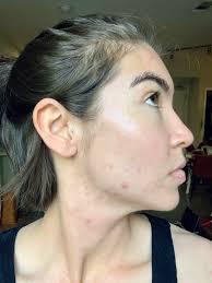 How much is accutane with insurance. Everything You Want To Know About Taking Accutane A Pa S Perspective Couture In Clinic