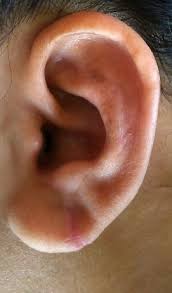 Thank you, {{form.email}}, for signing up. Dermabrasion In Earlobe Repair Journal Of The American Academy Of Dermatology