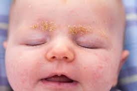Image result for white scabs on the head in children