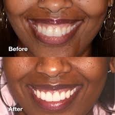 Invisalign Seattle