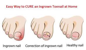 Pin On Toes