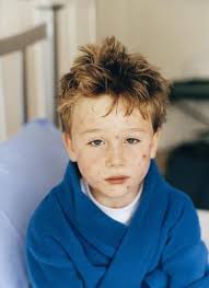 Image result for shingles in children