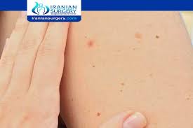 سرطان الاعضاء التناسلية للرجل