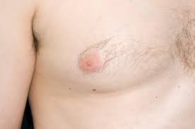 Male breast cancer does occur and it looks on a mammogram the same as female. Breast Cancer In Men Brainstrom