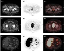 05.12.2013 · imaging techniques play a significant role in staging of prostate cancer and mri is the most accurate imaging modality used for prostate cancer staging. Choline Pet And Pet Ct In Primary Diagnosis And Staging Of Prostate Cancer