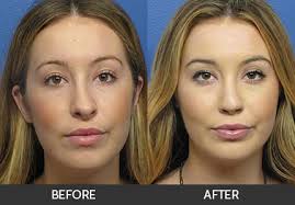 Revision Rhinoplasty Gallery