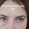 What does prf stand for? 1