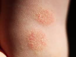 Image result for Eczema nummulare