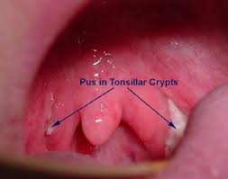 This material is provided for educational purposes only and is not intended for medical advice, diagnosis or treatment. Mononucleosi Incubazione Malattie Sintomi Mononucleosi