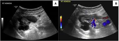 Benign multicystic peritoneal mesothelioma (bmpm) is a rare tumor that occurs mainly in women in their reproductive age. Imaging Appearance Of Benign Multicystic Peritoneal Mesothelioma A Case Report And Review Of The Literature Sciencedirect