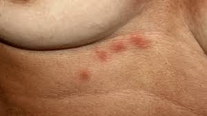 Image result for heat rash under breasts