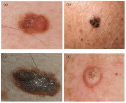 Skin cancer is the most common type of cancer in the united states by a pretty large margin, and it does not discriminate. Four Examples Of Skin Lesions A Dysplastic Nevus B Seborrheic Download Scientific Diagram