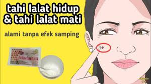 Cara Menghilangkan Tahi Lalat Dengan Bahan Alami Youtube