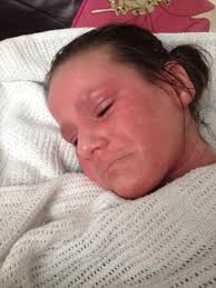 Case studies of children and adults with atopic eczema being treated under  the Aron regime