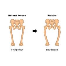 Image result for Rickets