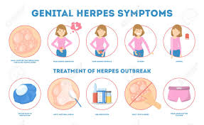 I read that you started thinking up a possible cure for herpes around 10 years ago. This New Cure For Herpes Can Stop The Infection Before It S Too Late