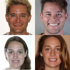 Transformation Tuesday. Over the years we have and the pleasure of working  with @digiortho doing tons of orthognathic(jaw) surgery cases. These cases  transform lives more than anything that we do. They improve