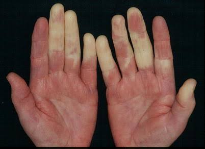 raynaud disease ile ilgili görsel sonucu"