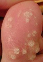 Compound w pictures of dying plantar warts. Wart Wikipedia