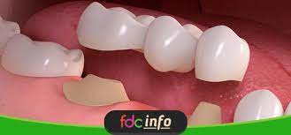 Sementara itu, gigi palsu lepasan. Apa Itu Crown Dan Bridges Apakah Sama Dengan Gigi Palsu Fdc Dental Clinic