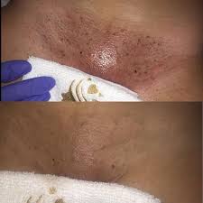 An ingrown hair boil on vagina can show up after shaving the pubic hairs using inappropriate shaving techniques. Yoni Spa Room A Vajacial Is Performed On Your Vulva Facebook
