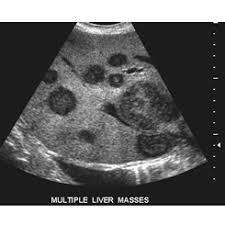 The usual indication for an ultrasound for breast cancer would be a suspicious finding. Ultrasound Imaging Cancerquest