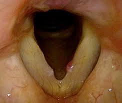 Image result for Acute Laryngitis