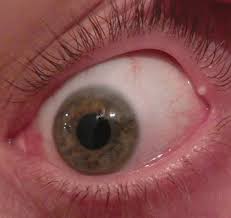 Stye Vs Stye In essence, the stye (sty) on eyelid is a small, painful lump on the edge of the eyelid or in eye, causing pain and swelling. review of optometry