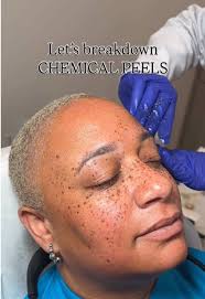 Peeling for Team Explained