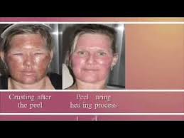 Youtube Chemical Peel Chemical Peel Cost Facial Peel