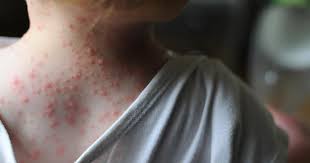 This is a condition marked by a low number of red blood other causes, red spots on the skin can occur due to allergic reactions such as purpura allergic. Skin Conditions In Babies