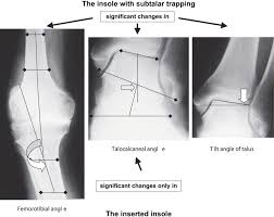 Image result for Talar Tilt