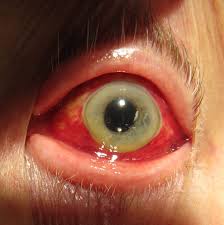 I have personally been using blogger for years, and while some don't like it, i think it is one of the better blogging engines online. Red Eye Medicine Wikipedia