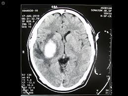 Gli infarti cerebrali e le emorragie intraparenchimali sono leggermente più frequenti nei. Ematoma Intracranico Che Cos E Sintomi Cause Prevenzione E Trattamento Top Doctors