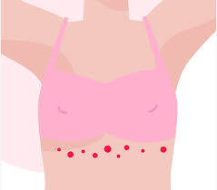 Image result for Candidiasis under breasts