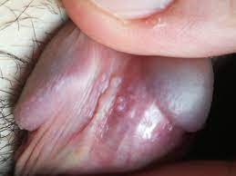 Tyson Glands Or Warts? Conflicting Diagnosis! (Pics) | Penis Disorders |  Forums | Patient