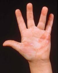 To treat this, you will wear a splint on your hand/forearm. Burns Injuries And Poisoning Merck Manuals Consumer Version