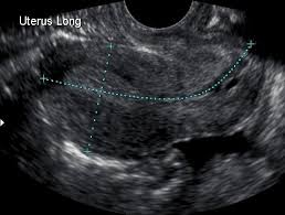Ovarian cancer has been nicknamed the silent killer because there are said to be few signs and symptoms in the early stages of the disease. Normal Uterus Ultrasound How To