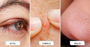 'milia are small white bumps or cysts that appear on the surface of the skin when dead skin cells become trapped,' explains consultant dermatologist dr. Eyelid Bumps 101 How To Identify Styes Milia Pimples Allure