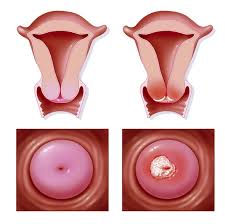 Cervical cancer is a cancer of the cervix. Cervical Cancer Amazing Free Trick Could Prevent The Dangerous Cancer Express Co Uk